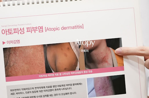 생기한의원이 설명하는 아토피 가려움과 태선화의 관계