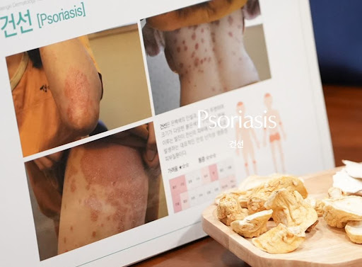 생기한의원이 설명하는 건선 원인 복합 요인 이해하기